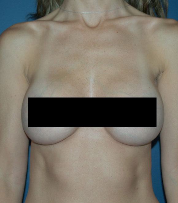 breast aug after