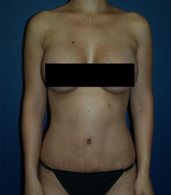 tummy tuck after